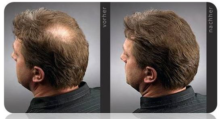 Восстановить волосы для мужчин